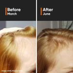 Minimalist Hair Growth Serum With 3% Redensyl, 3% Anagain, 3% Procapil, 5% Capixyl & 4% Baicapil 18% For Men & Women  30 ml - Image 3