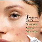 Acne Spot Corrector Gel