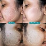 Pilgrim Korean 2% Salicylic Acid + 3% Glycolic Acid Anti Acne Serum for Oily & Acne Prone Skin - 30 ml - Image 5