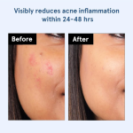 Acne Pimple Patch