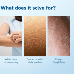 10% Urea Body Lotion
