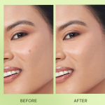 Acne Pimple Patches