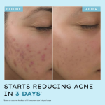 Hyphen Anti Acne 10% Azelaic Acid