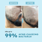 Hyphen Clarifying Acne Face Wash