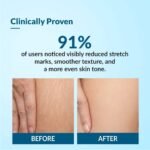 Fixderma Strallium Stretch Mark Cream